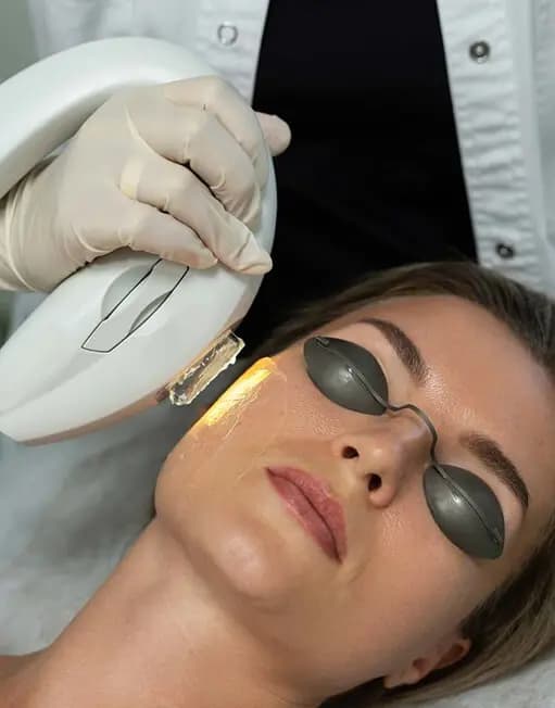 IPL Skin Rejuvenation